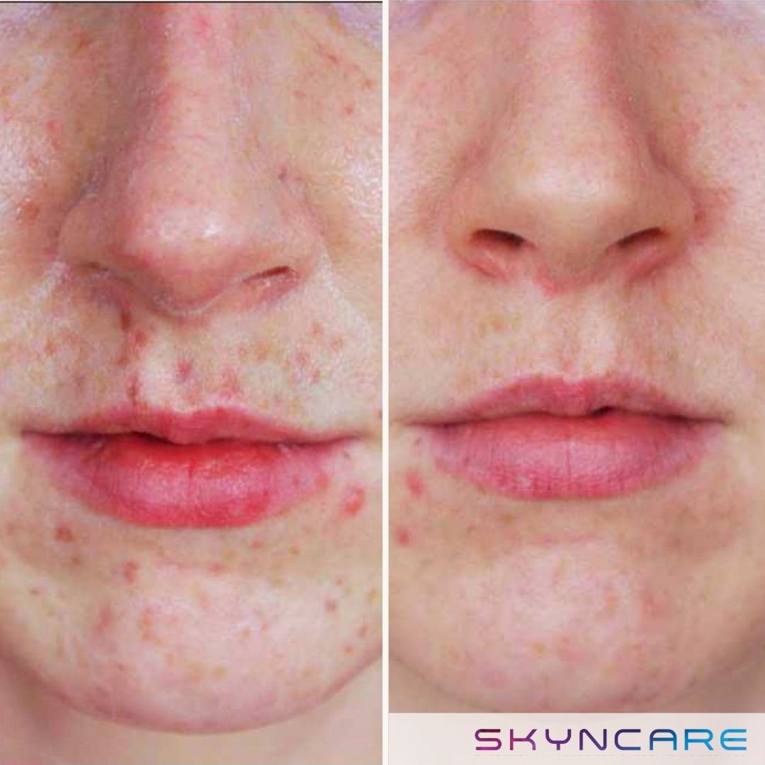 Before and after IPL treatment for acne