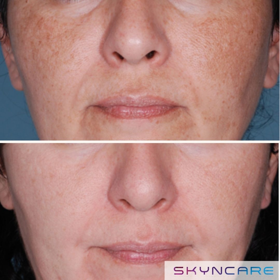 Before and after IPL treatment for facial pigmentation