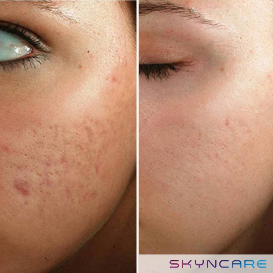 Before and after IPL treatment for acne scarring