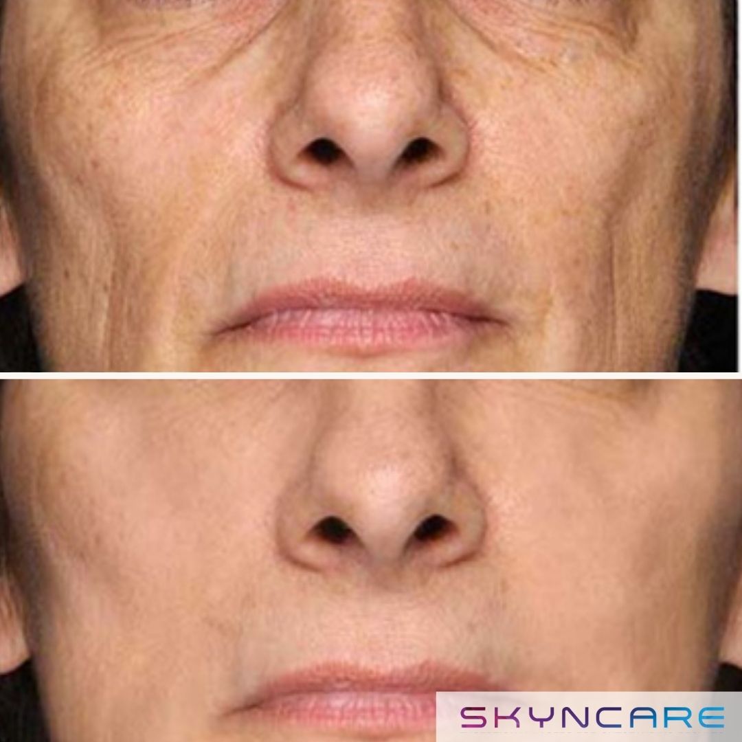 Before and after IPL treatment for lines around the mouth