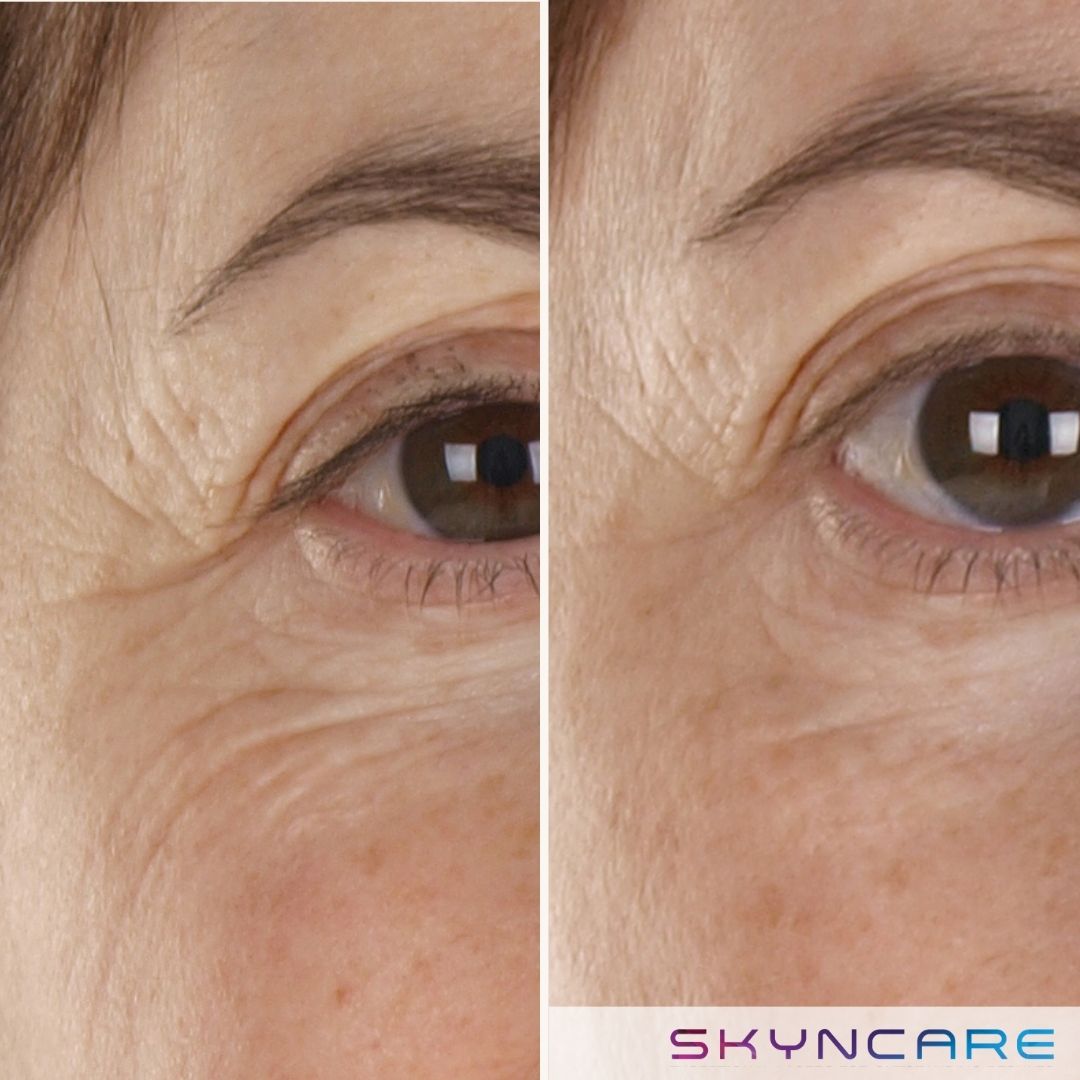 Before and after IPL treatment for fine lines around the eye