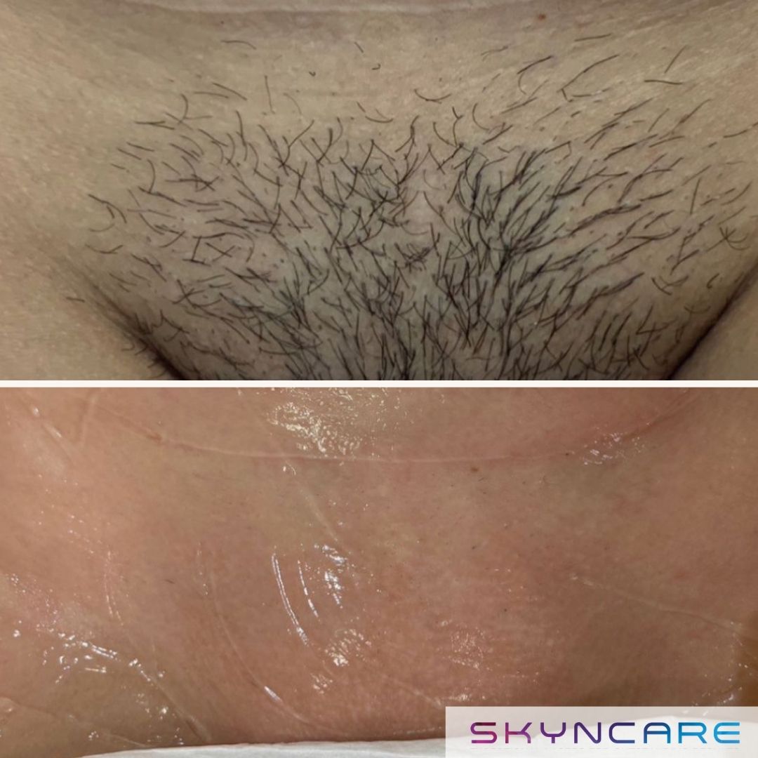 Before and after IPL hair removal on the bikini area